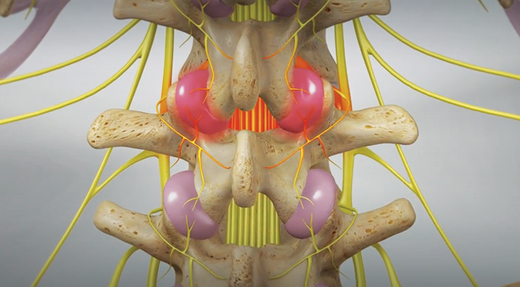 Transcutaneous Electrical Nerve Stimulation in Physical Therapy